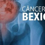 Campanha para prevenção do câncer de bexiga