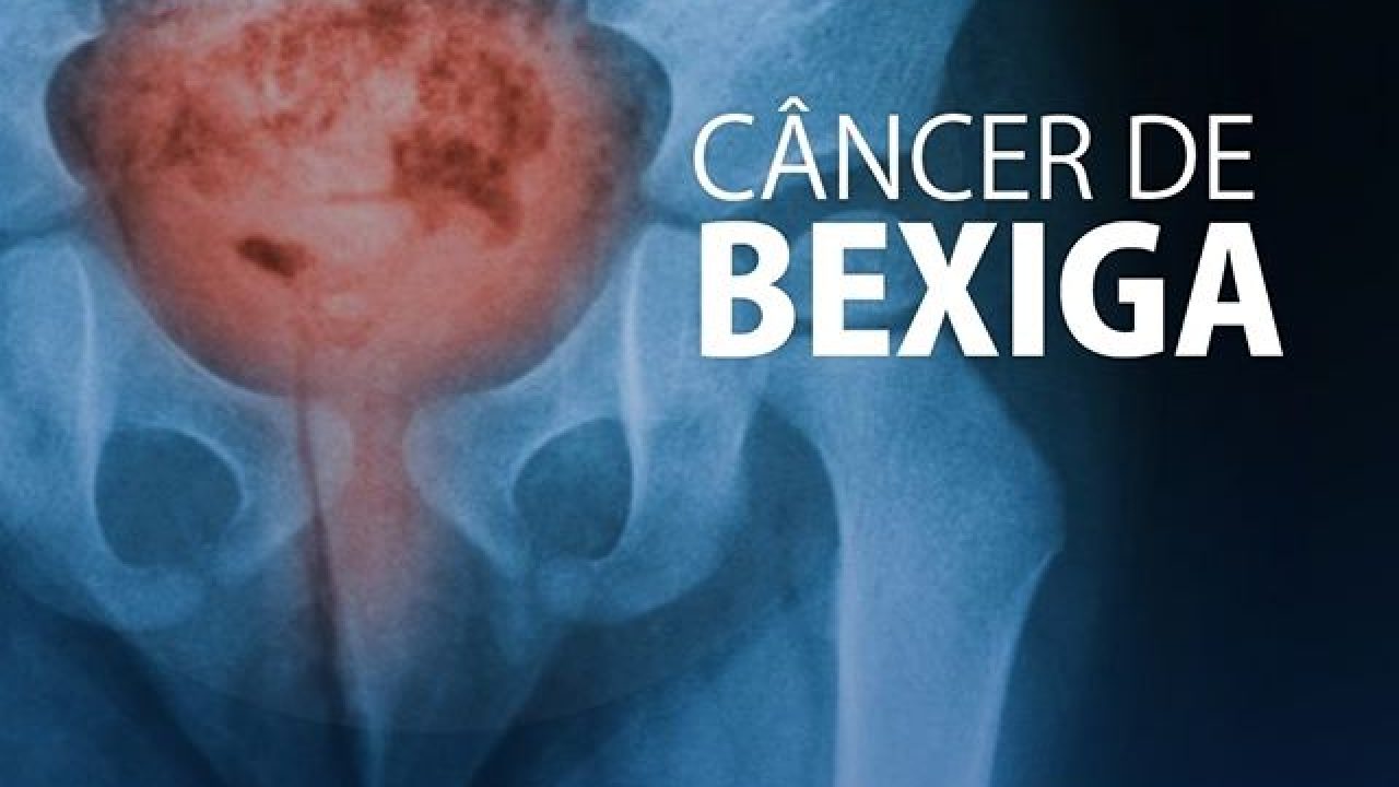Campanha para prevenção do câncer de bexiga